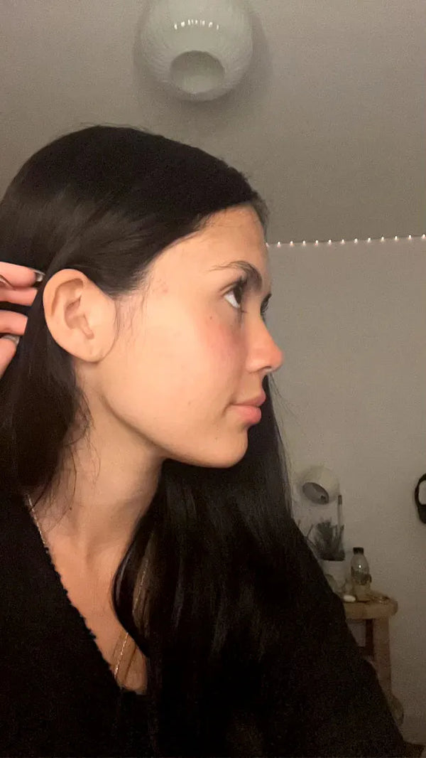 ACNE, REDNESS